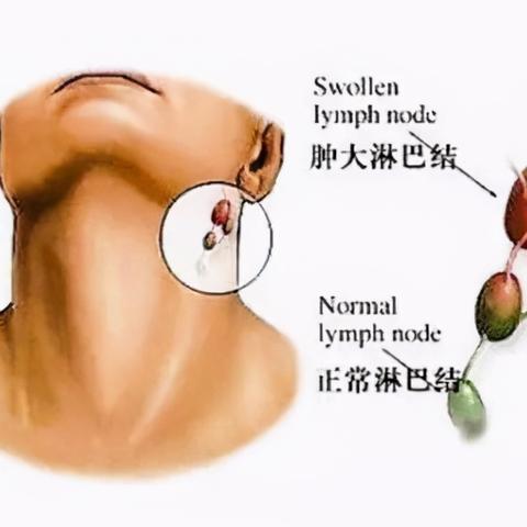 革新篇章，甲亢最新疗法揭秘，守护甲状腺健康